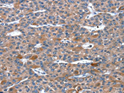 The image on the left is immunohistochemistry of paraffin-embedded Human liver cancer tissue using CSB-PA521847(RGS11 Antibody) at dilution 1/20, on the right is treated with fusion protein. (Original magnification: ×200)