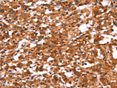 The image on the left is immunohistochemistry of paraffin-embedded Human thyroid cancer tissue using CSB-PA522630(GABRA1 Antibody) at dilution 1/30, on the right is treated with synthetic peptide. (Original magnification: ×200)