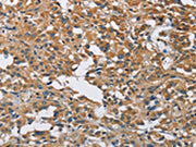 The image on the left is immunohistochemistry of paraffin-embedded Human thyroid cancer tissue using CSB-PA522891(DNMT3A Antibody) at dilution 1/50, on the right is treated with fusion protein. (Original magnification: ×200)