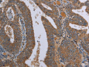 The image on the left is immunohistochemistry of paraffin-embedded Human colon cancer tissue using CSB-PA523947(LCMT1 Antibody) at dilution 1/20, on the right is treated with fusion protein. (Original magnification: ×200)