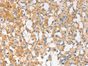 The image on the left is immunohistochemistry of paraffin-embedded Human thyroid cancer tissue using CSB-PA524180(EPS15L1 Antibody) at dilution 1/30, on the right is treated with fusion protein. (Original magnification: ×200)