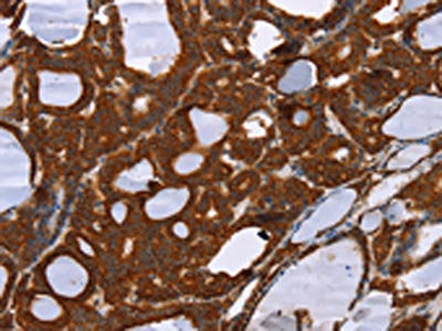 The image on the left is immunohistochemistry of paraffin-embedded Human thyroid cancer tissue using CSB-PA524640(PPP2R3C Antibody) at dilution 1/30, on the right is treated with fusion protein. (Original magnification: ×200)