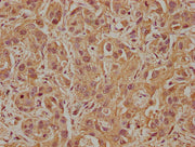 IHC image of CSB-PA525315LA01HU diluted at 1:100 and staining in paraffin-embedded human liver cancer performed on a Leica BondTM system. After dewaxing and hydration, antigen retrieval was mediated by high pressure in a citrate buffer (pH 6.0). S...