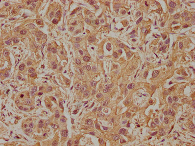 IHC image of CSB-PA525315LA01HU diluted at 1:100 and staining in paraffin-embedded human liver cancer performed on a Leica BondTM system. After dewaxing and hydration, antigen retrieval was mediated by high pressure in a citrate buffer (pH 6.0). S...