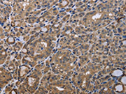 The image is immunohistochemistry of paraffin-embedded Human thyroid cancer tissue using CSB-PA526376(GADD45B Antibody) at dilution 1/40. (Original magnification: ×200)