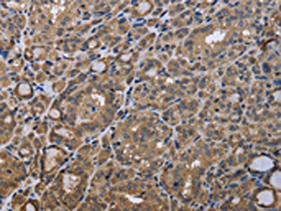 The image is immunohistochemistry of paraffin-embedded Human thyroid cancer tissue using CSB-PA526376(GADD45B Antibody) at dilution 1/40. (Original magnification: ×200)