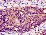 Immunohistochemistry of paraffin-embedded human colon cancer using CSB-PA526447YA01HU at dilution of 1:100
