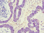 Immunohistochemistry of paraffin-embedded human ovarian cancer using CSB-PA527261ESR2HU at dilution of 1:100