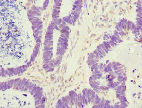 Immunohistochemistry of paraffin-embedded human ovarian cancer using CSB-PA527261ESR2HU at dilution of 1:100