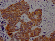 IHC image of CSB-PA527261LA01HU diluted at 1:100 and staining in paraffin-embedded human ovarian cancer performed on a Leica BondTM system. After dewaxing and hydration, antigen retrieval was mediated by high pressure in a citrate buffer (pH 6.0)....