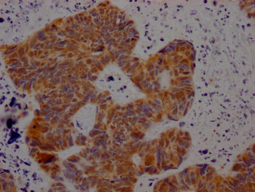 IHC image of CSB-PA527261LA01HU diluted at 1:100 and staining in paraffin-embedded human ovarian cancer performed on a Leica BondTM system. After dewaxing and hydration, antigen retrieval was mediated by high pressure in a citrate buffer (pH 6.0)....