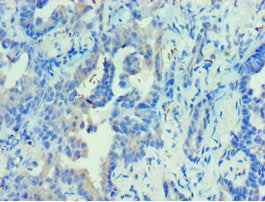 Immunohistochemistry of paraffin-embedded human lung cancer using CSB-PA527326ESR2HU at dilution of 1:100
