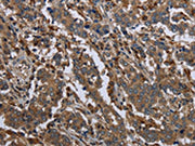 The image on the left is immunohistochemistry of paraffin-embedded Human liver cancer tissue using CSB-PA528498(GYS2 Antibody) at dilution 1/40, on the right is treated with fusion protein. (Original magnification: ×200)