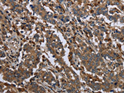 The image on the left is immunohistochemistry of paraffin-embedded Human liver cancer tissue using CSB-PA528498(GYS2 Antibody) at dilution 1/40, on the right is treated with fusion protein. (Original magnification: ×200)
