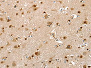 The image on the left is immunohistochemistry of paraffin-embedded Human brain tissue using CSB-PA529294(SLIT3 Antibody) at dilution 1/30, on the right is treated with synthetic peptide. (Original magnification: ×200)