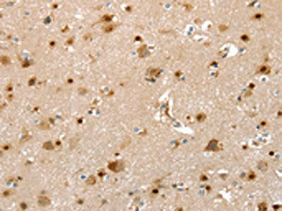 The image on the left is immunohistochemistry of paraffin-embedded Human brain tissue using CSB-PA529294(SLIT3 Antibody) at dilution 1/30, on the right is treated with synthetic peptide. (Original magnification: ×200)