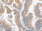 The image on the left is immunohistochemistry of paraffin-embedded Human colon cancer tissue using CSB-PA530130(PARD6A Antibody) at dilution 1/60, on the right is treated with fusion protein. (Original magnification: ×200)
