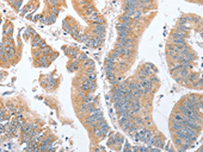 The image on the left is immunohistochemistry of paraffin-embedded Human colon cancer tissue using CSB-PA530130(PARD6A Antibody) at dilution 1/60, on the right is treated with fusion protein. (Original magnification: ×200)