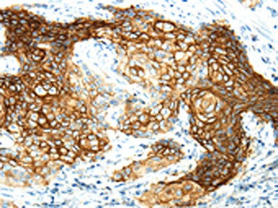 The image on the left is immunohistochemistry of paraffin-embedded Human cervical cancer tissue using CSB-PA531552(AQP3 Antibody) at dilution 1/30, on the right is treated with synthetic peptide. (Original magnification: ×200)