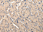 The image on the left is immunohistochemistry of paraffin-embedded Human liver cancer tissue using CSB-PA532216(SERPINA7 Antibody) at dilution 1/30, on the right is treated with fusion protein. (Original magnification: ×200)