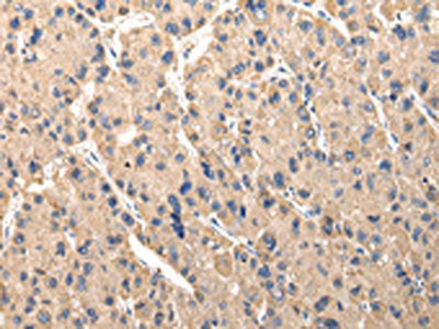 The image on the left is immunohistochemistry of paraffin-embedded Human liver cancer tissue using CSB-PA532216(SERPINA7 Antibody) at dilution 1/30, on the right is treated with fusion protein. (Original magnification: ×200)