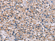 The image on the left is immunohistochemistry of paraffin-embedded Human prostate cancer tissue using CSB-PA533274(ADAM12 Antibody) at dilution 1/40, on the right is treated with synthetic peptide. (Original magnification: ×200)
