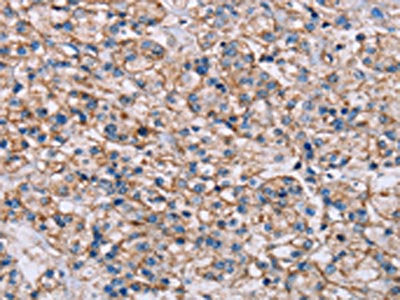 The image on the left is immunohistochemistry of paraffin-embedded Human prostate cancer tissue using CSB-PA533274(ADAM12 Antibody) at dilution 1/40, on the right is treated with synthetic peptide. (Original magnification: ×200)