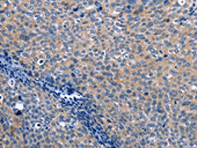 The image on the left is immunohistochemistry of paraffin-embedded Human cervical cancer tissue using CSB-PA533514(LXN Antibody) at dilution 1/25, on the right is treated with fusion protein. (Original magnification: ×200)