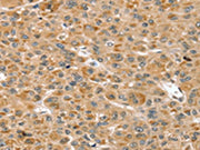 The image on the left is immunohistochemistry of paraffin-embedded Human liver cancer tissue using CSB-PA534045(RNH1 Antibody) at dilution 1/30, on the right is treated with fusion protein. (Original magnification: ×200)