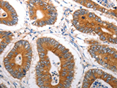 The image on the left is immunohistochemistry of paraffin-embedded Human colon cancer tissue using CSB-PA539726(SLC12A6 Antibody) at dilution 1/40, on the right is treated with synthetic peptide. (Original magnification: ×200)