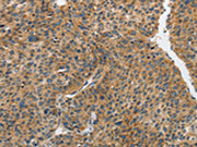 The image on the left is immunohistochemistry of paraffin-embedded Human liver cancer tissue using CSB-PA540033(PIP5K1C Antibody) at dilution 1/25, on the right is treated with synthetic peptide. (Original magnification: ×200)