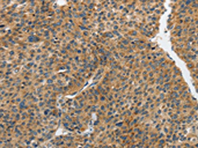 The image on the left is immunohistochemistry of paraffin-embedded Human liver cancer tissue using CSB-PA540033(PIP5K1C Antibody) at dilution 1/25, on the right is treated with synthetic peptide. (Original magnification: ×200)