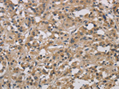 The image on the left is immunohistochemistry of paraffin-embedded Human thyroid cancer tissue using CSB-PA542036(DCN Antibody) at dilution 1/30, on the right is treated with fusion protein. (Original magnification: ×200)