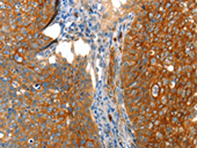 The image on the left is immunohistochemistry of paraffin-embedded Human cervical cancer tissue using CSB-PA545063(VWA5A Antibody) at dilution 1/80, on the right is treated with fusion protein. (Original magnification: ×200)