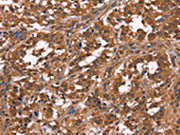 The image on the left is immunohistochemistry of paraffin-embedded Human gastic cancer tissue using CSB-PA545107(NOS2 Antibody) at dilution 1/40, on the right is treated with fusion protein. (Original magnification: ×200)