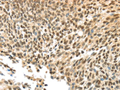 The image on the left is immunohistochemistry of paraffin-embedded Human tonsil tissue using CSB-PA545148(APOL6 Antibody) at dilution 1/60, on the right is treated with synthetic peptide. (Original magnification: ×200)