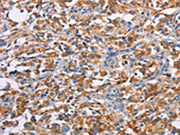 The image on the left is immunohistochemistry of paraffin-embedded Human thyroid cancer tissue using CSB-PA545216(PIM2 Antibody) at dilution 1/40, on the right is treated with fusion protein. (Original magnification: ×200)