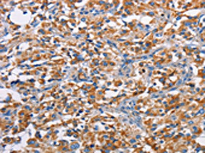 The image on the left is immunohistochemistry of paraffin-embedded Human thyroid cancer tissue using CSB-PA545216(PIM2 Antibody) at dilution 1/40, on the right is treated with fusion protein. (Original magnification: ×200)
