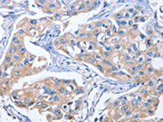 The image on the left is immunohistochemistry of paraffin-embedded Human breast cancer tissue using CSB-PA545336(IBSP Antibody) at dilution 1/50, on the right is treated with synthetic peptide. (Original magnification: ×200)