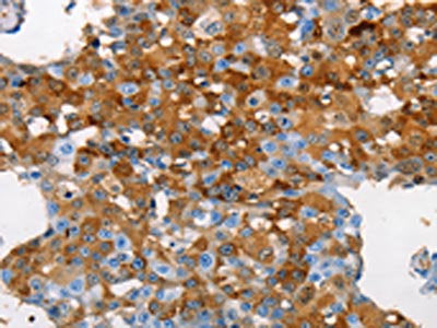 The image on the left is immunohistochemistry of paraffin-embedded Human cervical cancer tissue using CSB-PA545384(MUC5B Antibody) at dilution 1/70, on the right is treated with synthetic peptide. (Original magnification: ×200)