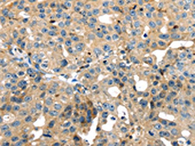 The image on the left is immunohistochemistry of paraffin-embedded Human breast cancer tissue using CSB-PA545504(SRPX Antibody) at dilution 1/35, on the right is treated with fusion protein. (Original magnification: ×200)
