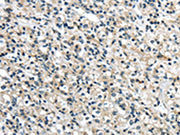The image on the left is immunohistochemistry of paraffin-embedded Human prostate cancer tissue using CSB-PA545861(GRIN2A Antibody) at dilution 1/35, on the right is treated with synthetic peptide. (Original magnification: ×200)