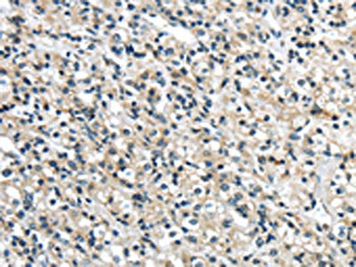 The image on the left is immunohistochemistry of paraffin-embedded Human prostate cancer tissue using CSB-PA545861(GRIN2A Antibody) at dilution 1/35, on the right is treated with synthetic peptide. (Original magnification: ×200)