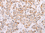The image on the left is immunohistochemistry of paraffin-embedded Human breast cancer tissue using CSB-PA546061(ADAMTS16 Antibody) at dilution 1/50, on the right is treated with synthetic peptide. (Original magnification: ×200)