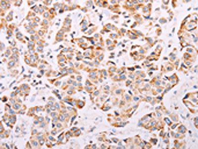 The image on the left is immunohistochemistry of paraffin-embedded Human breast cancer tissue using CSB-PA546061(ADAMTS16 Antibody) at dilution 1/50, on the right is treated with synthetic peptide. (Original magnification: ×200)