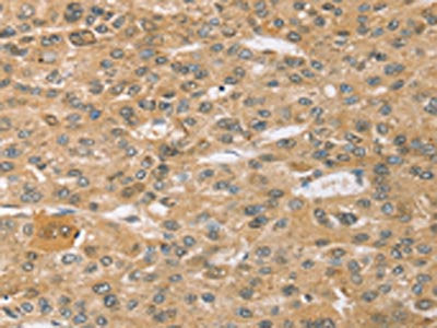 The image on the left is immunohistochemistry of paraffin-embedded Human liver cancer tissue using CSB-PA546167(SPON1 Antibody) at dilution 1/30, on the right is treated with synthetic peptide. (Original magnification: ×200)