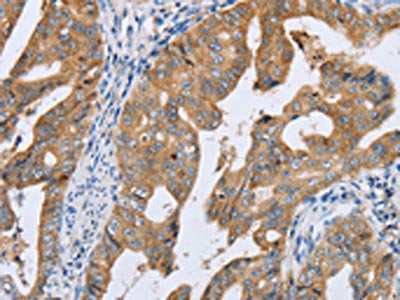 The image on the left is immunohistochemistry of paraffin-embedded Human gastic cancer tissue using CSB-PA546249(PTGER2 Antibody) at dilution 1/20, on the right is treated with synthetic peptide. (Original magnification: ×200)