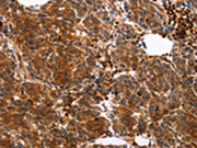 The image on the left is immunohistochemistry of paraffin-embedded Human breast cancer tissue using CSB-PA546360(YWHAB Antibody) at dilution 1/10, on the right is treated with synthetic peptide. (Original magnification: ×200)