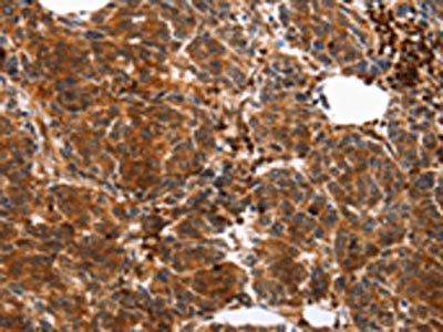 The image on the left is immunohistochemistry of paraffin-embedded Human breast cancer tissue using CSB-PA546360(YWHAB Antibody) at dilution 1/10, on the right is treated with synthetic peptide. (Original magnification: ×200)