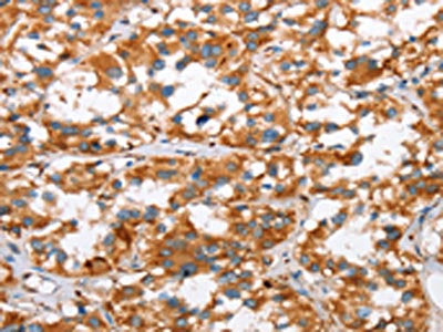 The image on the left is immunohistochemistry of paraffin-embedded Human thyroid cancer tissue using CSB-PA546462(SLC4A1 Antibody) at dilution 1/30, on the right is treated with synthetic peptide. (Original magnification: ×200)